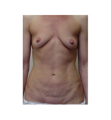 Breast Implant With Lower Abdominoplasty Before